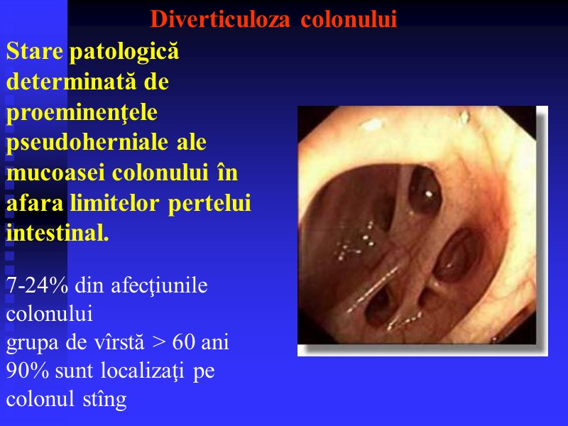 Diverticuloza colonului Stare patologică determinată de proeminenţele pseudoherniale ale mucoasei colonului în afara limitelor